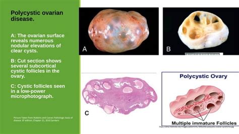 Pathology Of Polycystic Ovarian Disease And Endometriosis 2018 Sufia