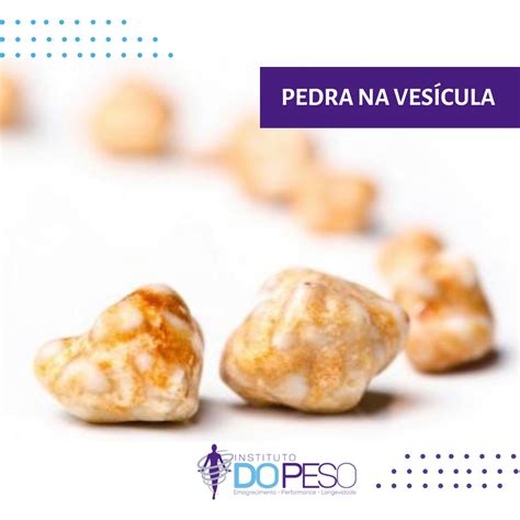 Cálculo ou pedra na vesícula Instituto do Peso