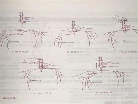 超详细讲解 臀大肌注射出现硬结怎么“破” 每日头条