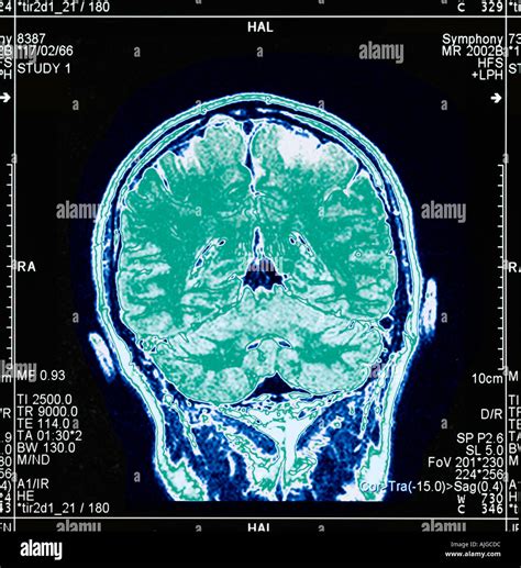 Magnetic Resonance Imaging Mri Of A Section Through A Human Head