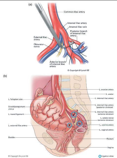 Table From Internal Iliac Hypogastric Artery Ligation Semantic