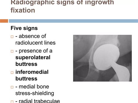 Aseptic Loosening Total Hip Arthroplasty Ppt