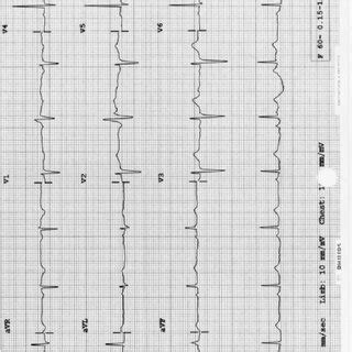 Twelve Lead Electrocardiogram Showing ST Segment Depression In Leads V4