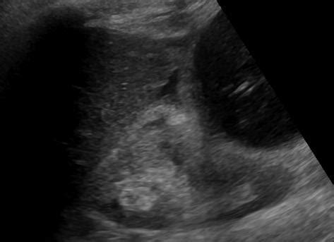 Abdomen and retroperitoneum | 1.2 Gallbladder and bile ducts : Case 1.2.6 Gallbladder ...