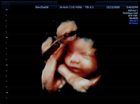 40 Weeks Pregnant Ultrasound