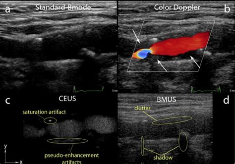 An example of a carotid artery image acquired with different ultrasound... | Download Scientific ...