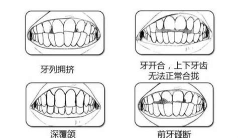 你的牙齒需要矯正麼？