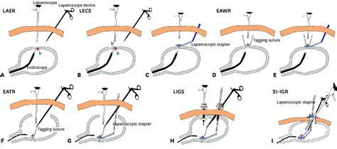 Lecs Procedures For Benign Gastric Tumors A Laer Red Circle Benign