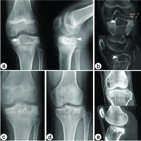 Preoperative And Postoperative Imaging Changes Of A Typical Proximal