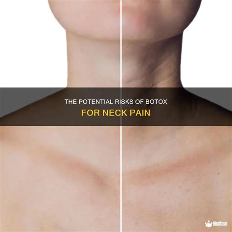 The Potential Risks Of Botox For Neck Pain Medshun