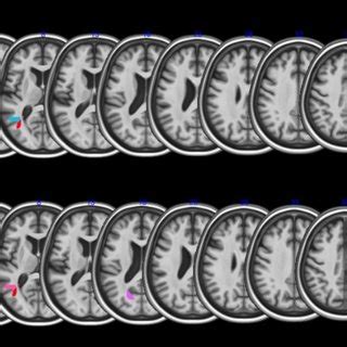 Vlsm Maps Showing Lesion Correlates Of Low Scores On Articulatory Motor