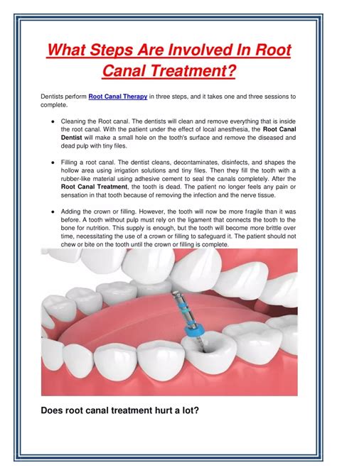 Ppt What Steps Are Involved In Root Canal Treatment Powerpoint