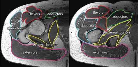 Us And Mri Of Pelvic Tendon Anatomy And Pathologic Conditions