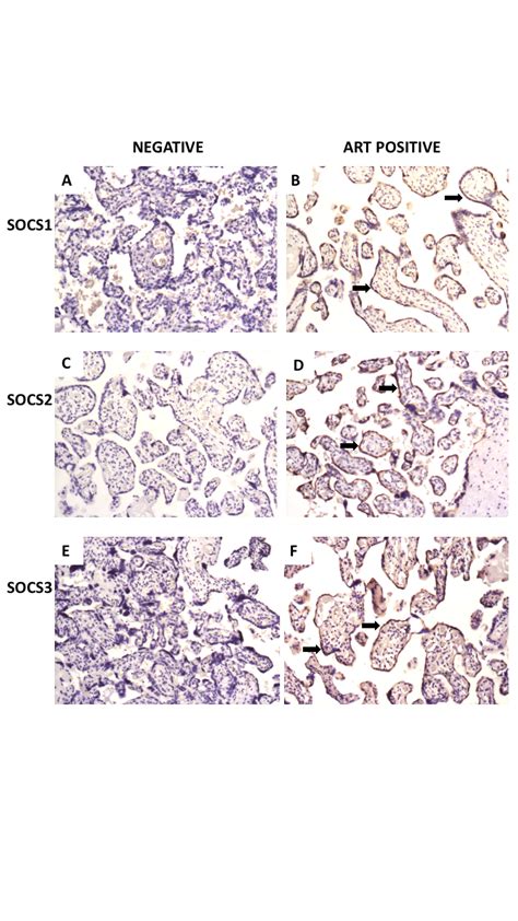 Representative Immunohistochemistry Micrographs For Socs 1 2 And 3