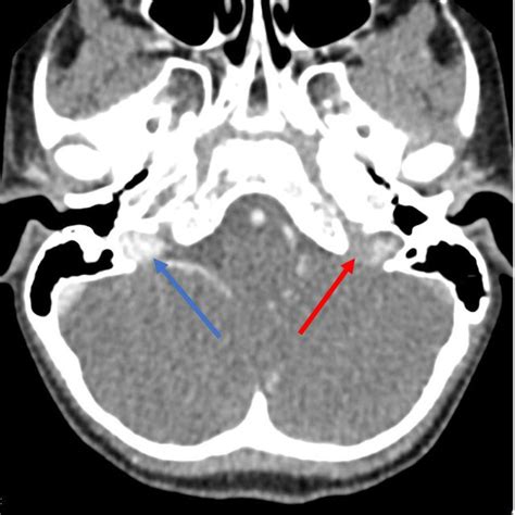 Axial Contrast‐enhanced Ct Of The Neck Demonstrating Normal Contrast Download Scientific