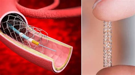 Qu Son Los Stents Y Para Qu Se Utilizan En Cardiolog A Portal Salud