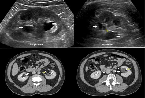 The Ultrasound Mimics Of Hydronephrosis Renal Fellow Network