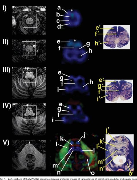 Figure 1 From High Resolution Diffusion Tensor Imaging Of The Brain