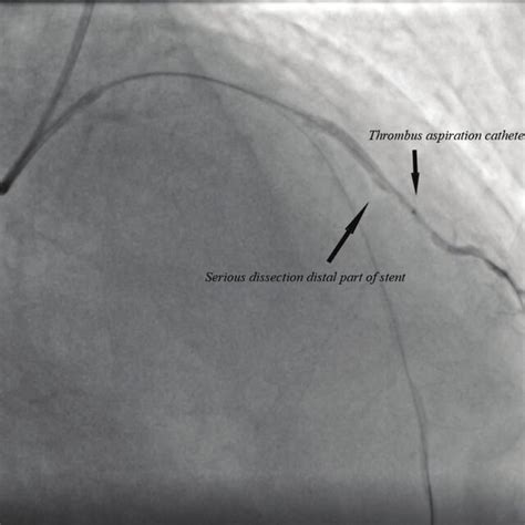 Serious Dissection Of The Distal Part Of The Stent In The D1 Artery D1