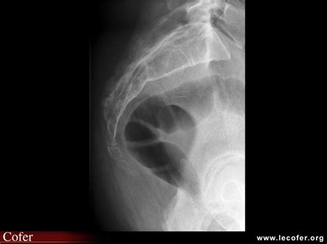 Radiographie du coccyx Diapothèque du COFER