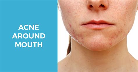 Why You Have Acne Around The Mouth And How To Get Rid Of It