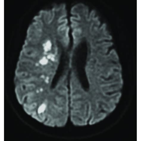 A Year Old Male Presented With Acute Onset Left Sided Weakness And