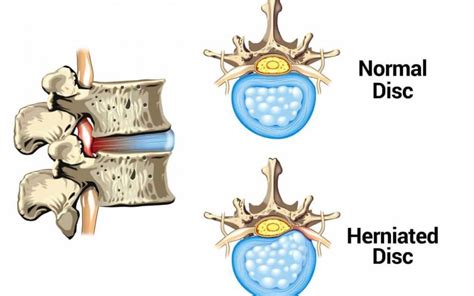 Common Injuries: What is a Herniated Disc?: Progressive Spine & Sports ...