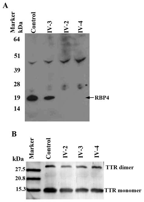 Serum Rbp4 And Ttr Levels Were Examined By Western Blot Analysis As