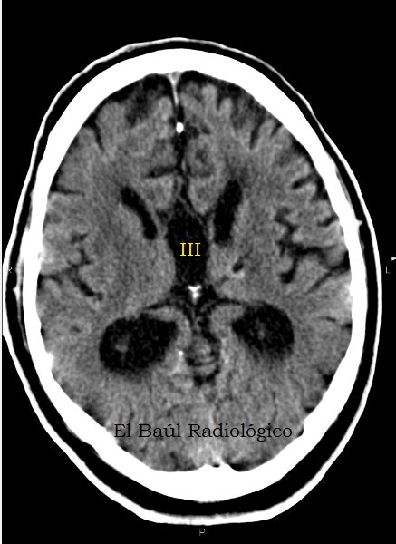 El Baúl Radiológico AGENESIA DEL CUERPO CALLOSO HALLAZGOS EN TC e IRM