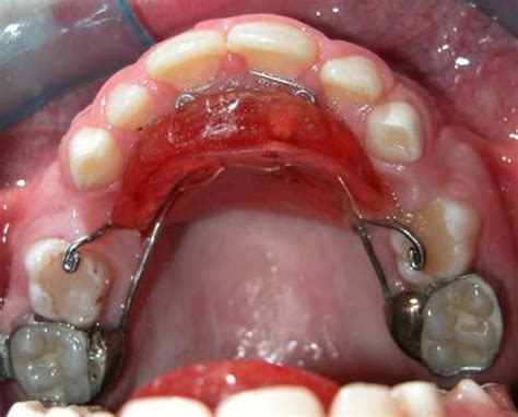 Anterior biteplane appliance | Download Scientific Diagram