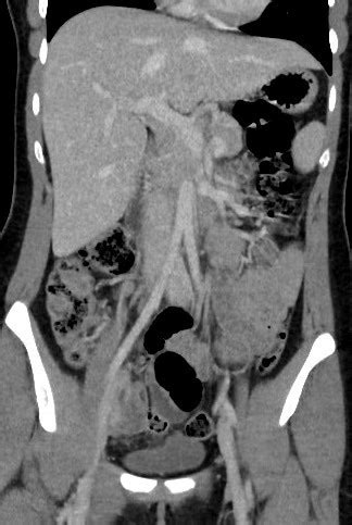 Scanner Abdomen Pelvis Diamorphos Imagerie M Dicale Brest