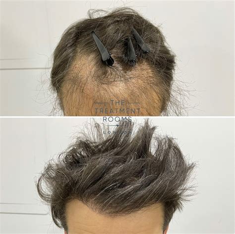 Why Choose Treatment Rooms Hair Transplant Specialists Treatment