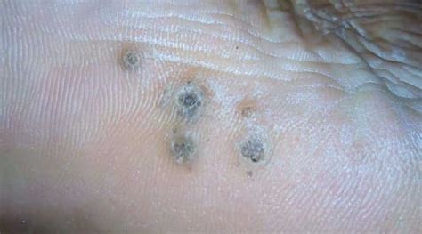 Planters Wart On Hand Removal Bruin Blog