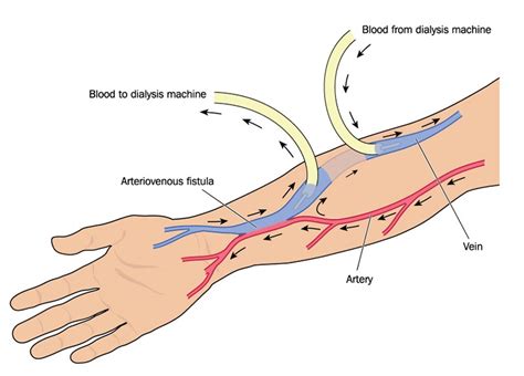 Restoring Quality Of Life With Vascular Access For Hemodialysis Royal