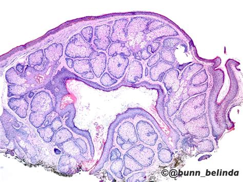 Sebaceous Hyperplasia Histology