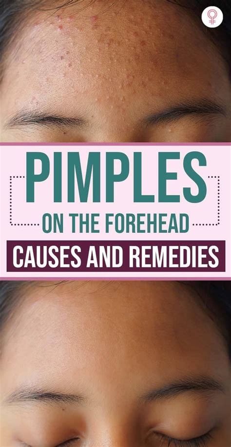 Pimples On The Forehead Causes And Remedies