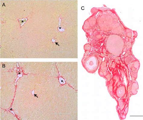 Picrosirius Red Staining Detects Fibrosis Liver Tissue Sections From Download Scientific