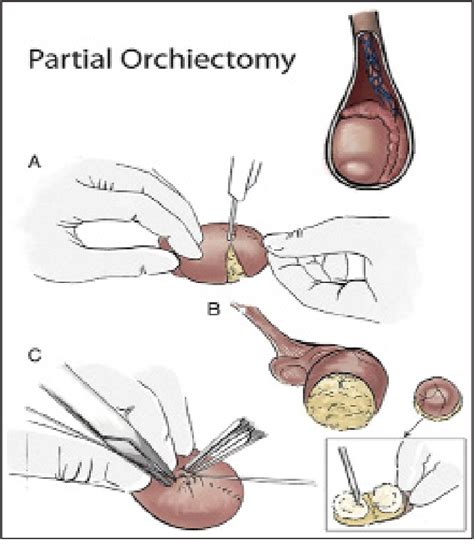 Figure 2 From Focal Surgery In Testis Cancer Current State Of The Art