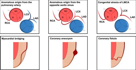 Coronary Artery Anomalies Circulation