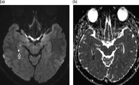 A Axial Mri Brain Dwi Sequence Shows Punctuate High Signal In Medial