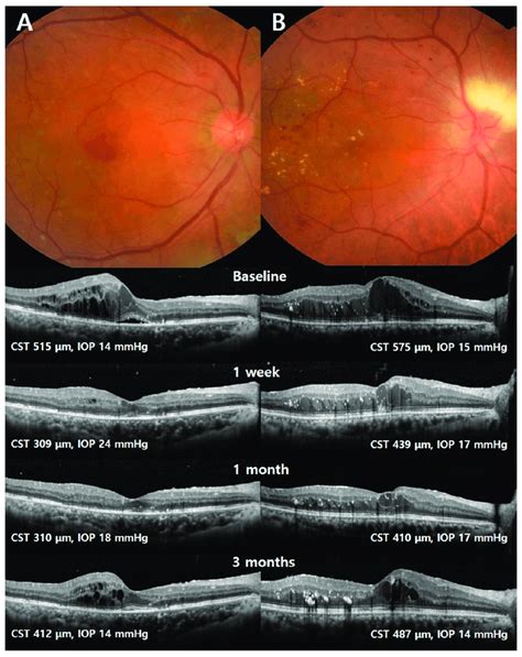 Fundus Photographs And Optical Coherence Tomography Oct Scans Of