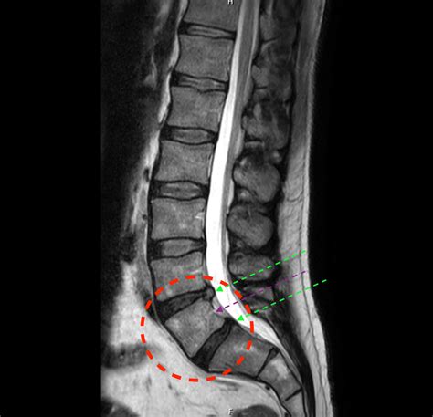 Lumbarised S1” The Transitional Potentially Mobile Lumbosacral