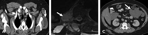 Imaging Of Liposarcoma Classification Patterns Of Tumor Recurrence