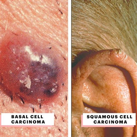 What Does Skin Cancer Look Like A Visual Guide To Warning Signs Allure