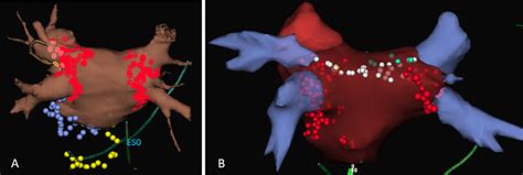 Electroanatomical Mapping With D Reconstruction Of The Left Atrium And