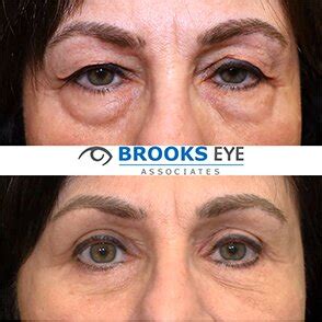 Blepharoplasty Eyelid Surgery In Plano Tx Brooks Eye Associates