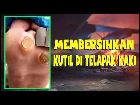 MEMBERSIHKAN KUTIL DI TELAPAK KAKI YouTube