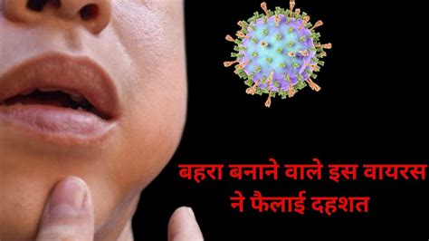 Mumps Virus राजस्‍थान में फैला इस खतरनाक वायरस का कहर बड़े बच्‍चे हो