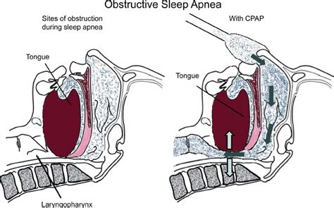 Representation Of The Effects Of Continuous Positive Airway Pressure