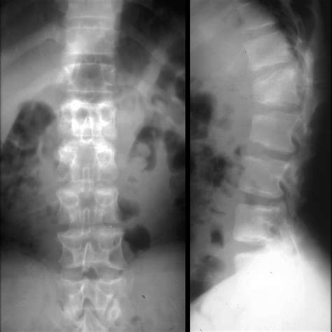 Achondroplasia X Ray Vs Normal